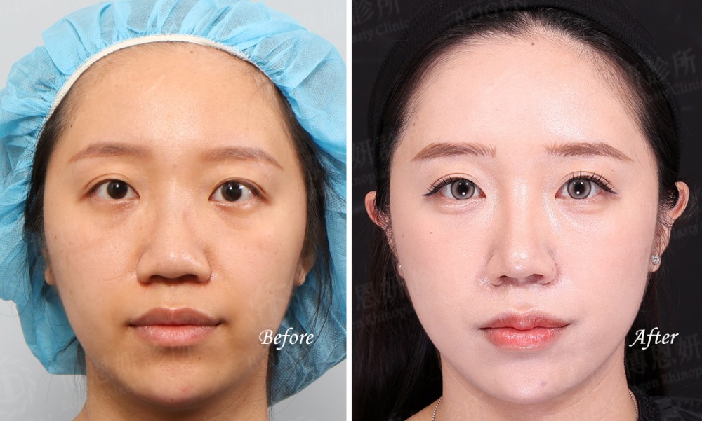 韓式隆鼻,結構式隆鼻,縮鼻翼手術,博恩妍